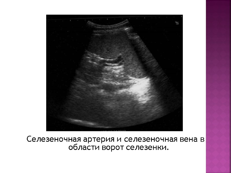 Селезеночная артерия и селезеночная вена в области ворот селезенки.